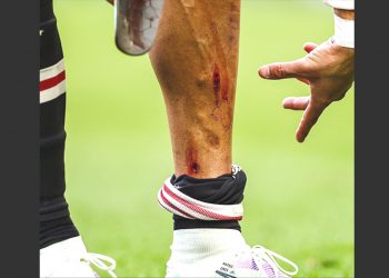 Kaki Ronaldo Berdarah