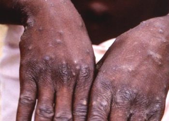 WHO Teliti Virus Cacar Monyet dalam Cairan Sperma