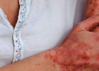 Kasus Cacar Monyet Terus Meningkat