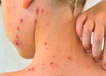 Lebih 3200 Kasus Cacar Monyet Dilaporkan ke WHO