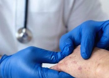 Kenali Gejala Penyakit Cacar Monyet