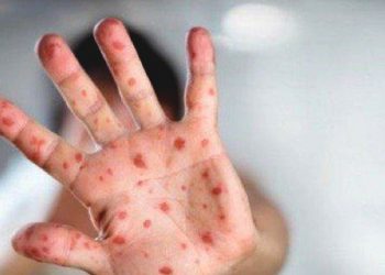 Indonesia Diminta Waspada Wabah Cacar Monyet